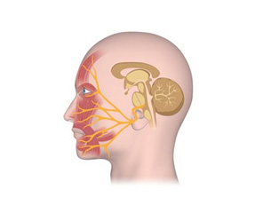 схематическое изображение невропатии лицевого нерва