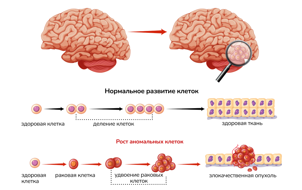 Астроцитома головного мозга: лечение диффузной, фибрилярной, астроцитома –  прогноз жизни после операции