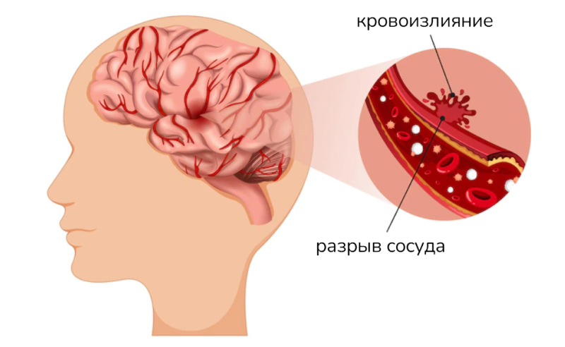 Воспаление коры головного мозга (менингит)