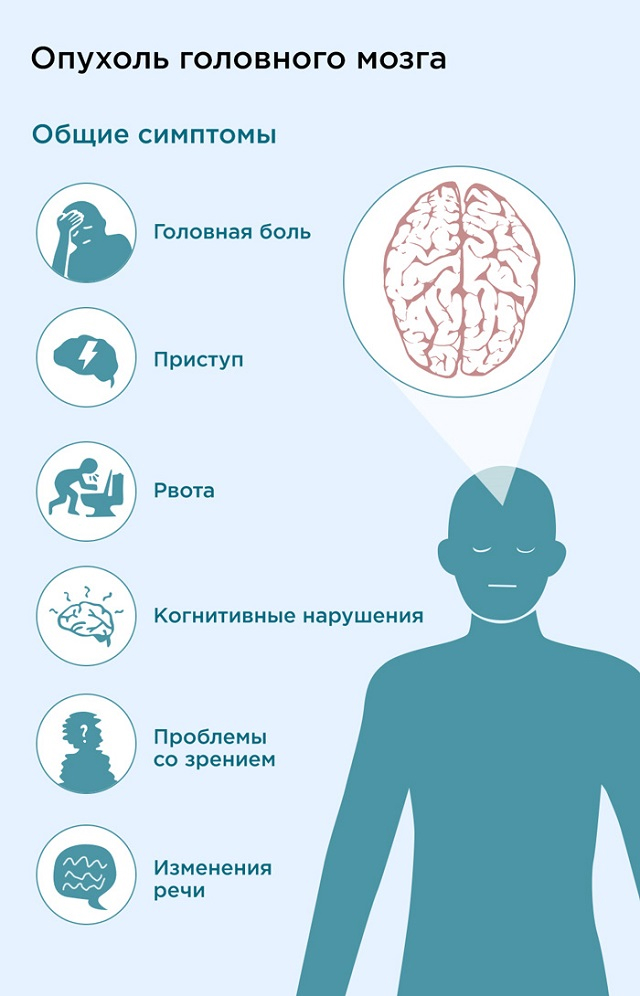 Симптомы опухоли головного мозга