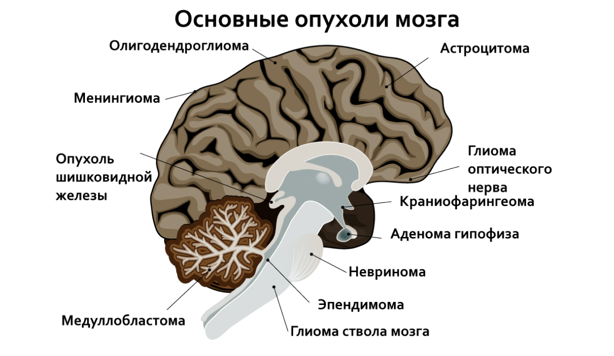 Основные опухоли головного мозга