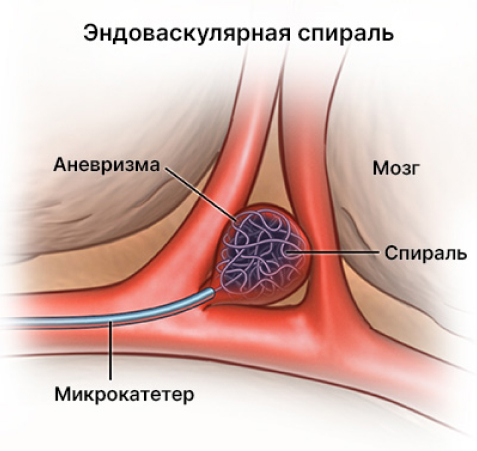 Эндоваскулярная спираль