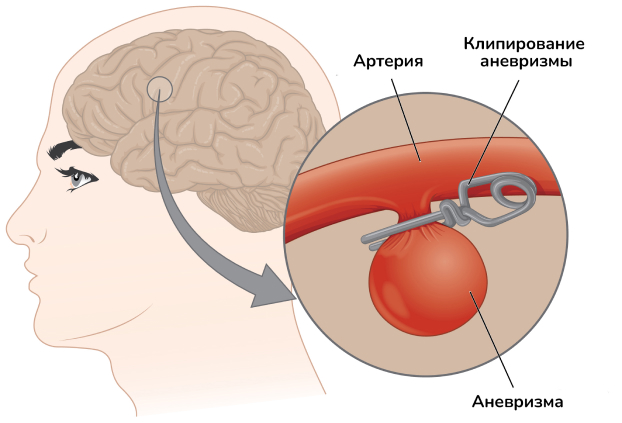 Схема клипирования аневризмы головного мозга