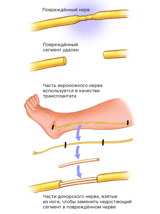 Схема пересадки нервных стволов