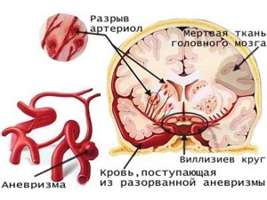 кровоизлияние в мозг из-за разорванной аневризмы